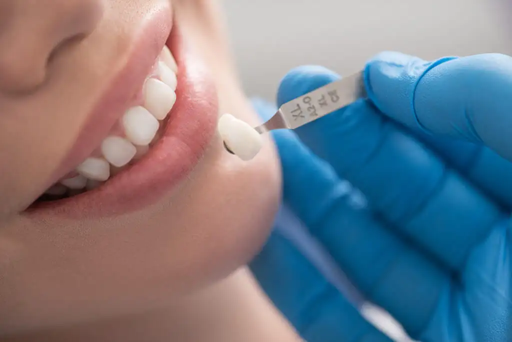 Bild von Veneers